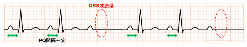 MobitzⅡ型Ⅱ度房室ブロック