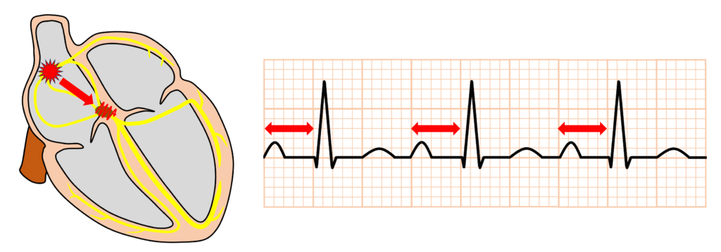 1度房室ブロック(First degree atrioventricular block)