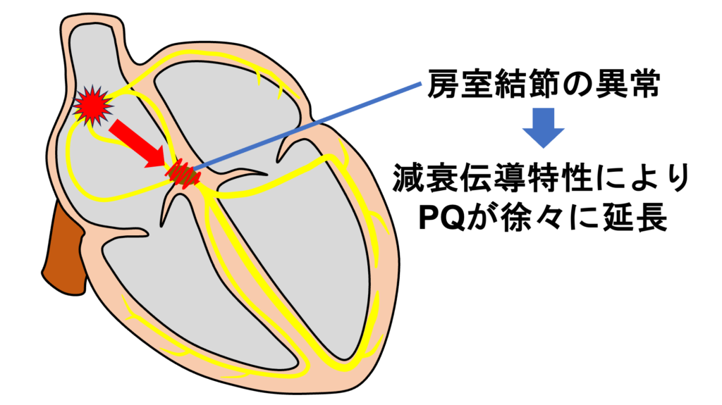 Wenckebach型Ⅱ度房室ブロック(Wenckebach second degree atrioventricular block)