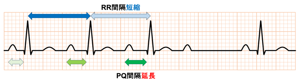 Wenckebach型Ⅱ度房室ブロック(Wenckebach second degree atrioventricular block)