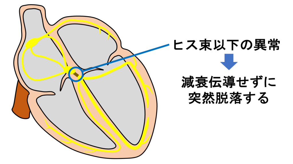 MobitzⅡ型Ⅱ度房室ブロック(Mobitz typeⅡ second degree atrioventricular block)