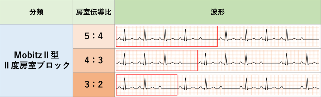 MobitzⅡ型Ⅱ度房室ブロック(Mobitz typeⅡ second degree atrioventricular block)