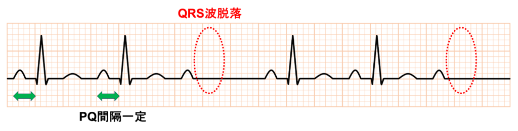 MobitzⅡ型Ⅱ度房室ブロック(Mobitz typeⅡ second degree atrioventricular block)