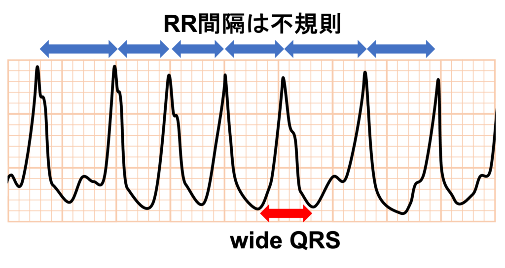 偽性心室頻拍(pseudo ventricular tachycardia)