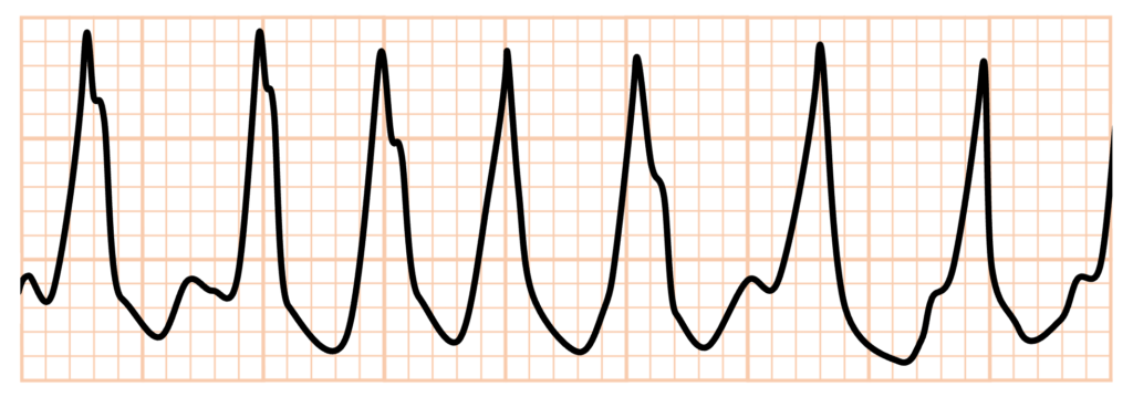 偽性心室頻拍(pseudo ventricular tachycardia)