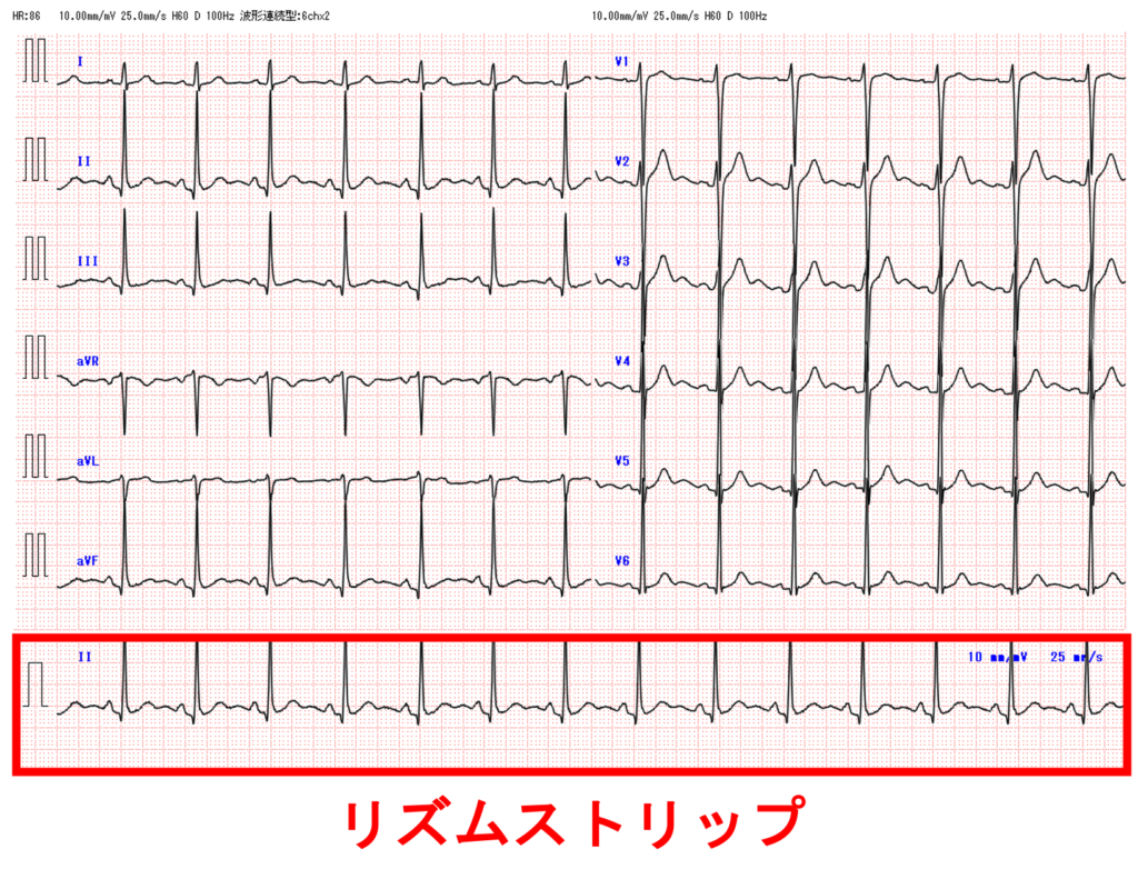 リズムストリップ(rhythm strip)
