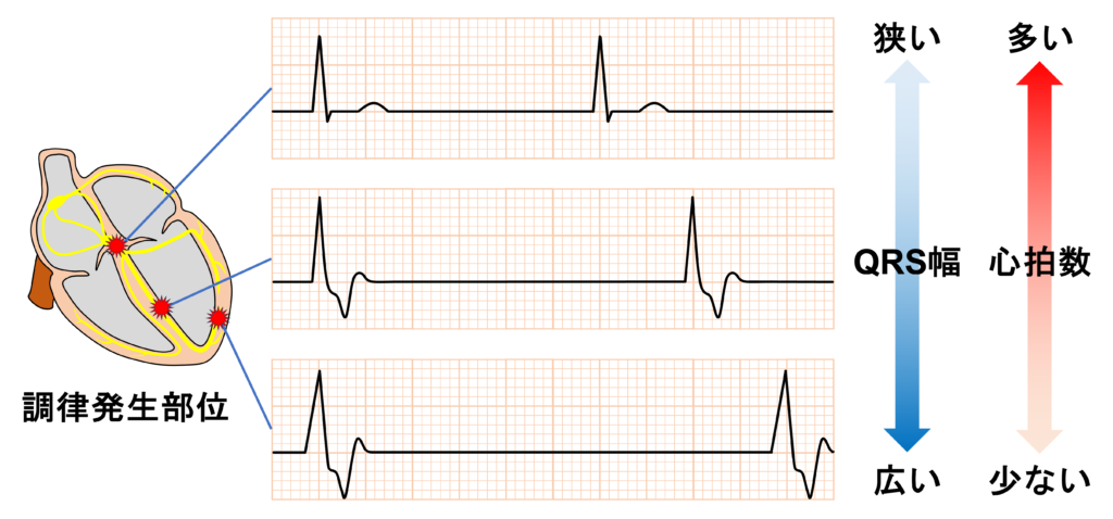 完全房室ブロック(complete atrioventricular block)