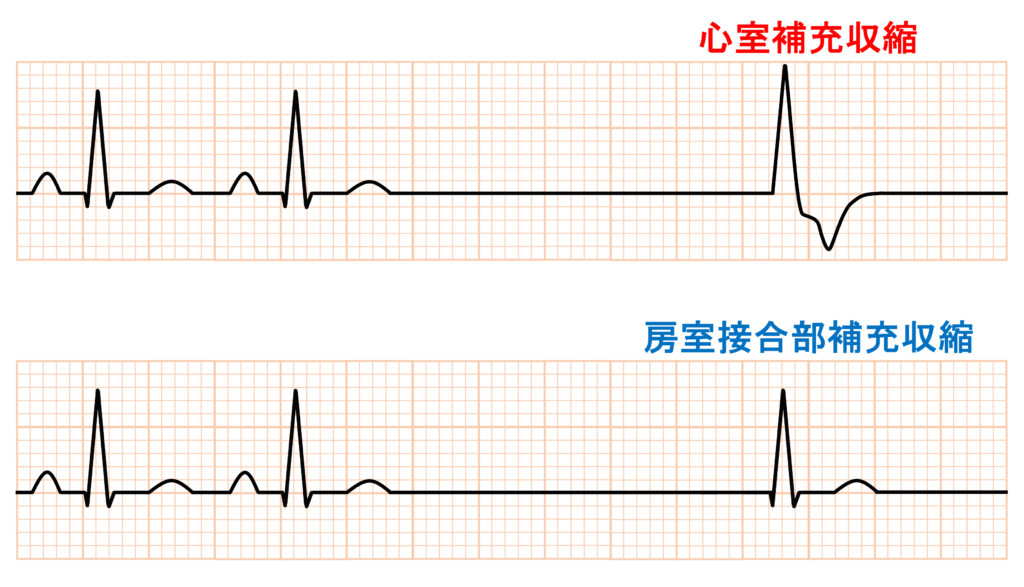 洞停止(sinus arrest)