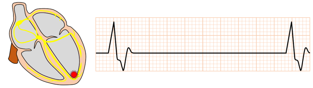 心室固有調律(idioventricular rhythm)
心室固有調律は心室筋から生じた補充調律であり、心室補充調律(ventricular escape rhythm)とも呼ばれます。通常は房室ブロックで見られることが多いです。