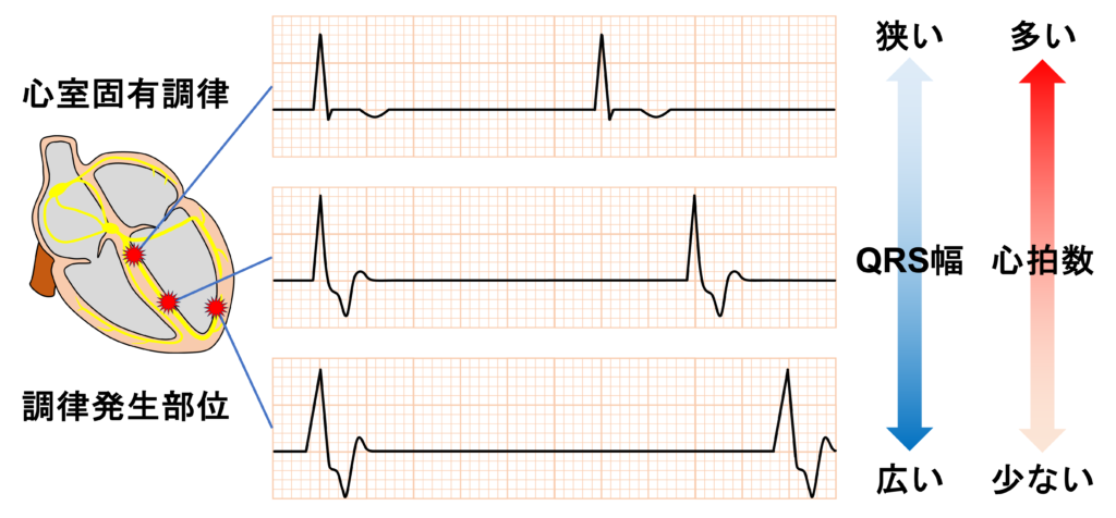 心室固有調律(idioventricular rhythm)
心室から興奮が開始するため、QRS波はwideとなります。調律の発生部位がヒス束に近いほどQRS幅は狭く、心拍数は30〜40/分程度となります。逆に、ヒス束から遠ざかるほどQRS幅は広く、心拍数は20〜30/分程度と少なくなります。