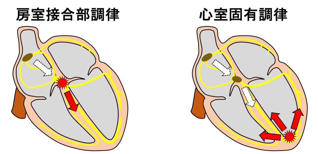 心室固有調律(idioventricular rhythm)
洞不全では基本的に房室接合部調律になりますが、房室接合部の機能障害がある場合はより下位の心室筋からの補充調律となりるため、心室固有調律が見られることがあります。