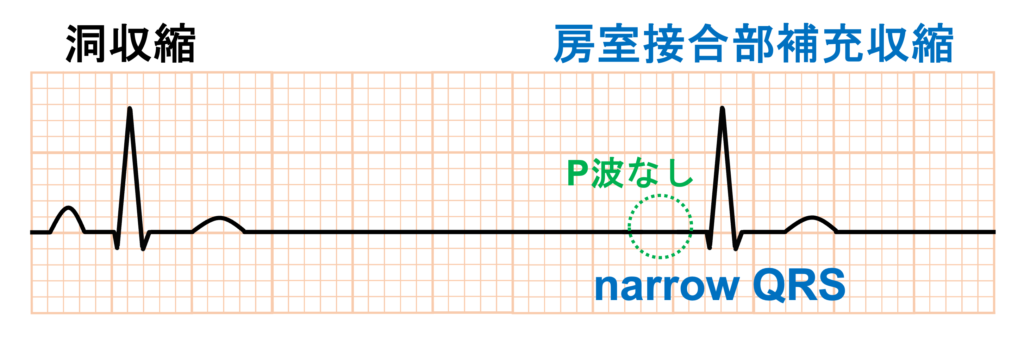 房室接合部補充収縮(junctional escape beat)
房室接合部補充収縮は先行するP波がなく、洞調律時のQRS波とほとんど同じ形の幅の狭い(narrow)QRS波として出現します。これは洞調律時とほとんど同じ経路を通って興奮が伝導するためです。