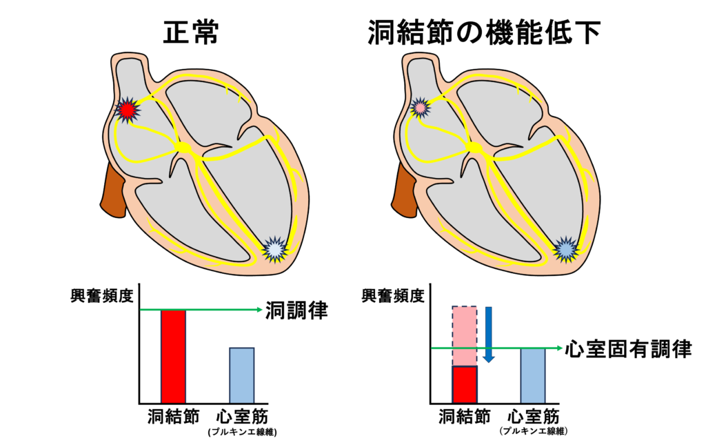 心室固有調律(idioventricular rhythm)
房室結節より下位の心室筋(プルキンエ線維)は20〜40/分程度の自動能を有しています。ベースとなる心拍がこの自動能より遅くなると補充収縮として心室固有調律が生じます。