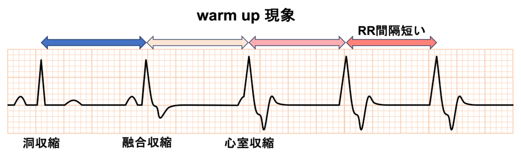 促進性心室固有調律(accelerated idioventricular rhythm：AIVR)
先行する洞調律(P波)が徐々にQRS波に追い越されていくことで開始することが多いです(warm up現象)。停止時は徐々に洞調律に切り替わる場合(cool down現象)と突然切り替わる場合があります。