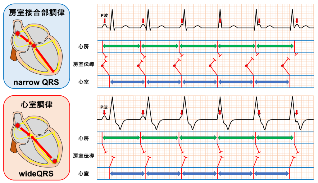 等頻度房室解離(isorhythmic atrioventricular dissociation)
