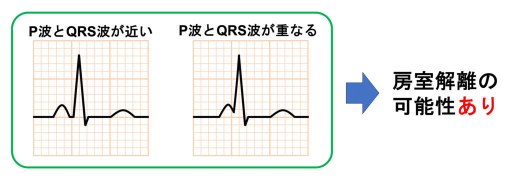 等頻度房室解離(isorhythmic atrioventricular dissociation)