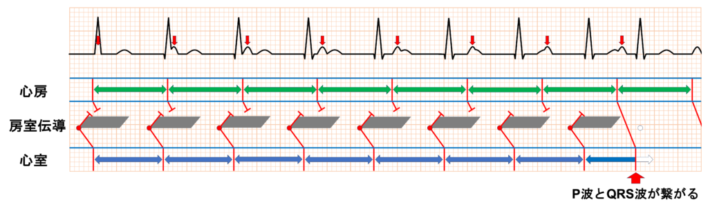 等頻度房室解離(isorhythmic atrioventricular dissociation)
完全房室ブロック
