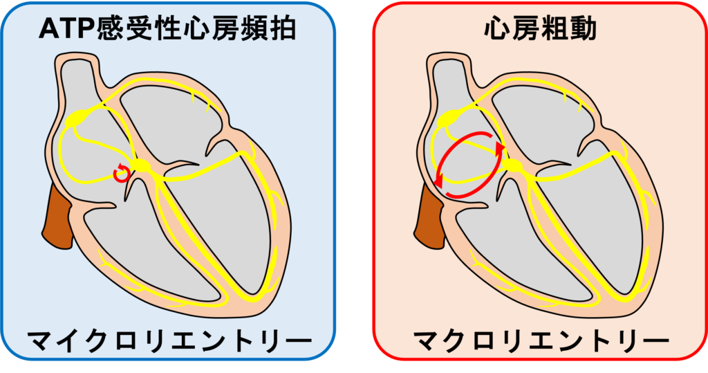 ATP感受性心房頻拍(ATP-sensitive atrial tachycardia)