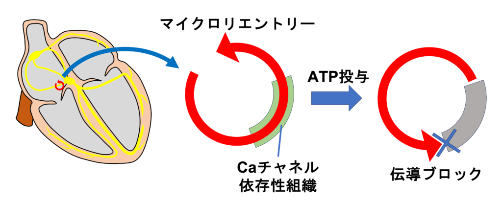 ATP感受性心房頻拍(ATP-sensitive atrial tachycardia)
