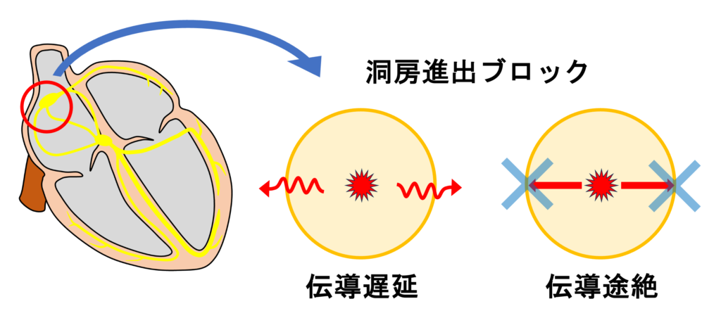 洞房ブロック(sinoatrial block)