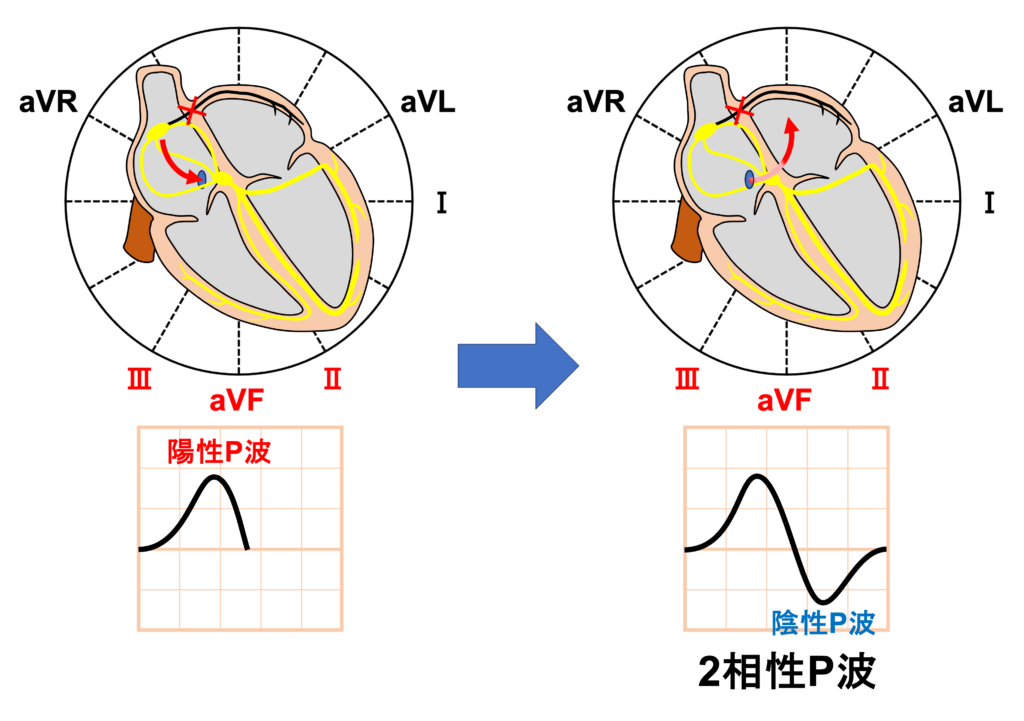 心房間ブロック(Interatrial Block：IAB)