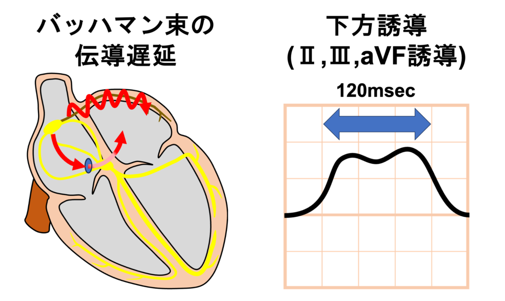心房間ブロック(Interatrial Block：IAB)