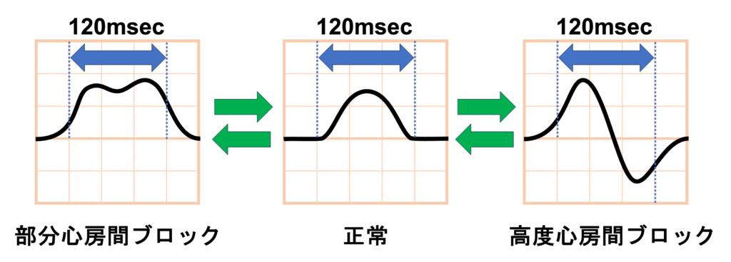 心房間ブロック(Interatrial Block：IAB)