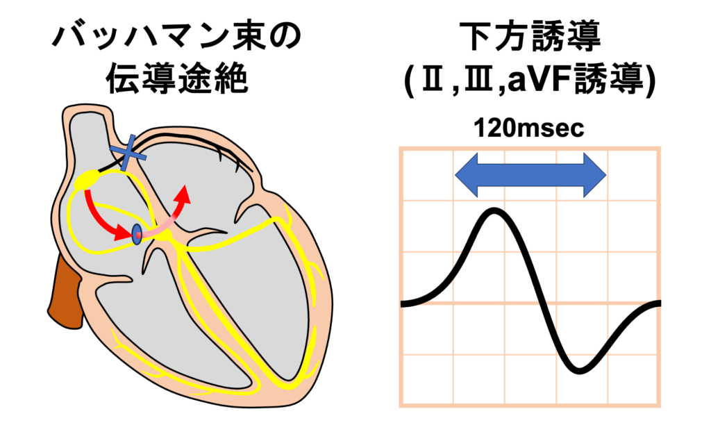 心房間ブロック(Interatrial Block：IAB)