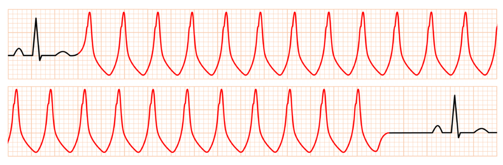 非持続性心室頻拍(Non-sustained ventricular tachycardia: NSVT)
NSVTの定義は普遍的なものではなく、文献によっては125拍/分または120拍/分で16拍の連続と定義されたり、15秒の時間カットオフを使用したり、あるいは厳密に定義された診断基準がない場合もあります2)。