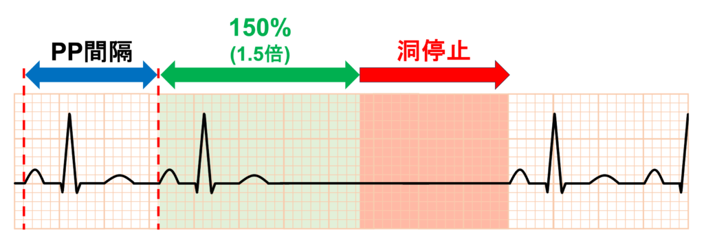 洞停止(sinus arrest)