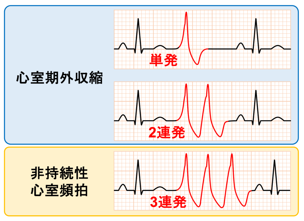 非持続性心室頻拍(Non-sustained ventricular tachycardia: NSVT)