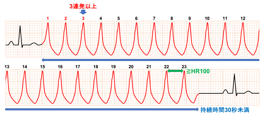 非持続性心室頻拍(Non-sustained ventricular tachycardia: NSVT)