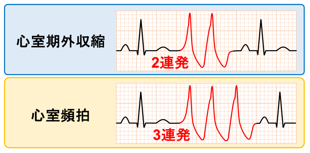 心室頻拍(Ventricular Tachycardia)