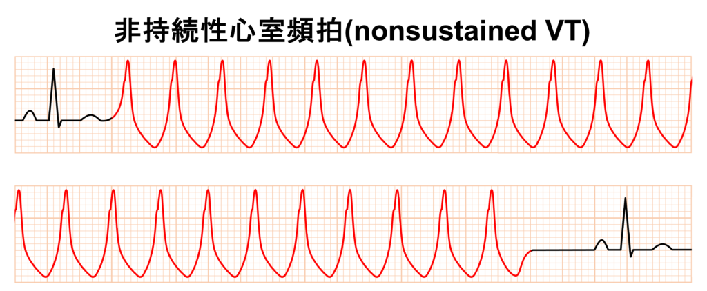 心室頻拍(Ventricular Tachycardia)