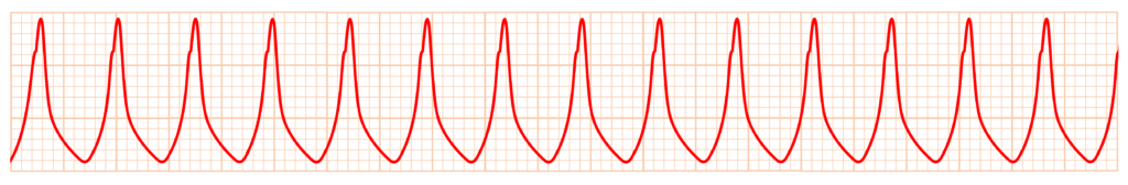 心室頻拍(Ventricular Tachycardia)