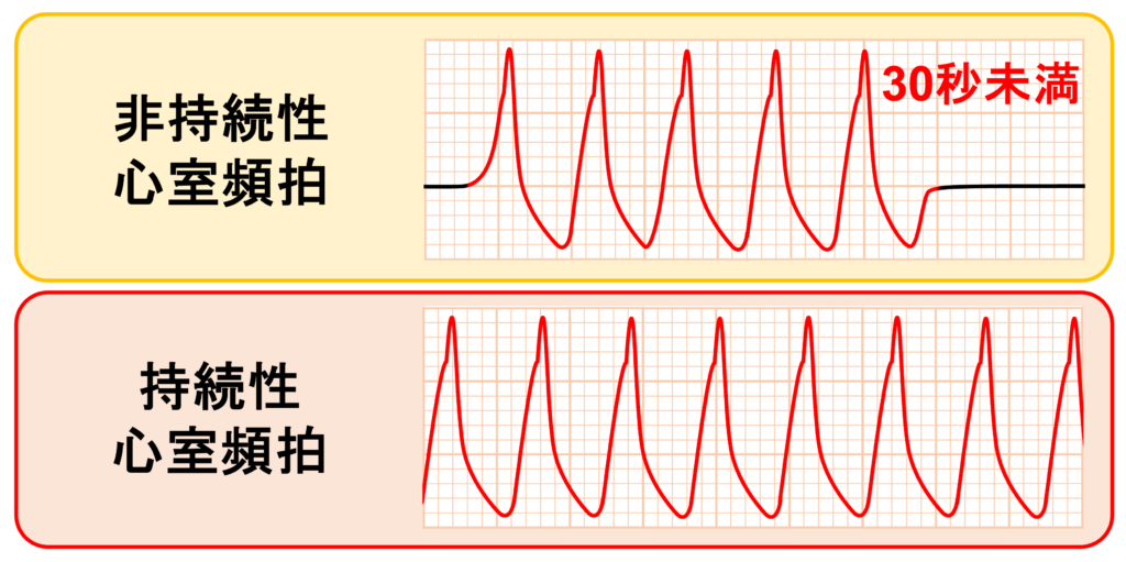 非持続性心室頻拍(Non-sustained ventricular tachycardia: NSVT)
非持続性心室頻拍は持続時間が30秒未満ですが、30秒以上持続する心室頻拍は持続性心室頻拍に分類されます。