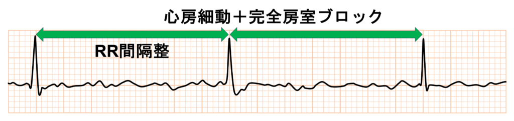 心房細動(Atrial fibrillation)