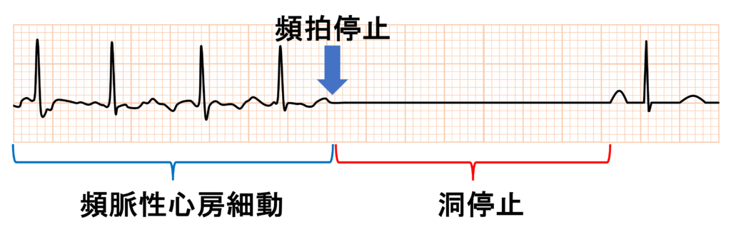 徐脈頻脈症候群(tachycardia-bradycardia syndrome)