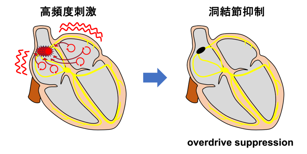 徐脈頻脈症候群(tachycardia-bradycardia syndrome)