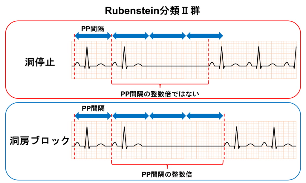 洞房ブロック(sinoatrial block)