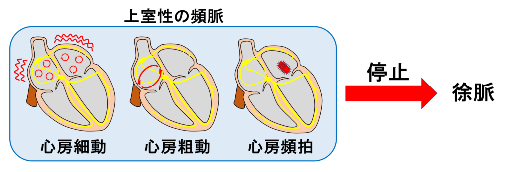 徐脈頻脈症候群(tachycardia-bradycardia syndrome)