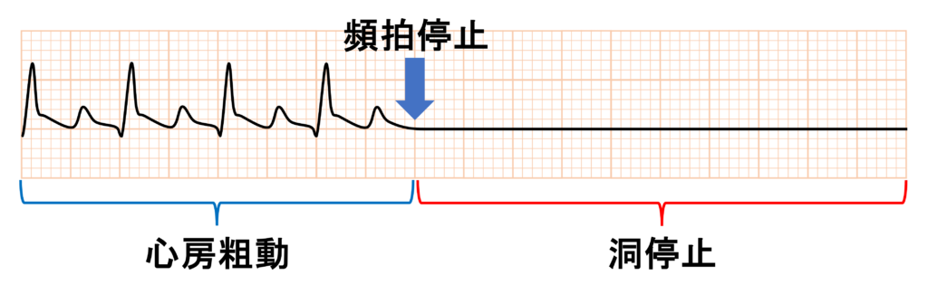 徐脈頻脈症候群(tachycardia-bradycardia syndrome)