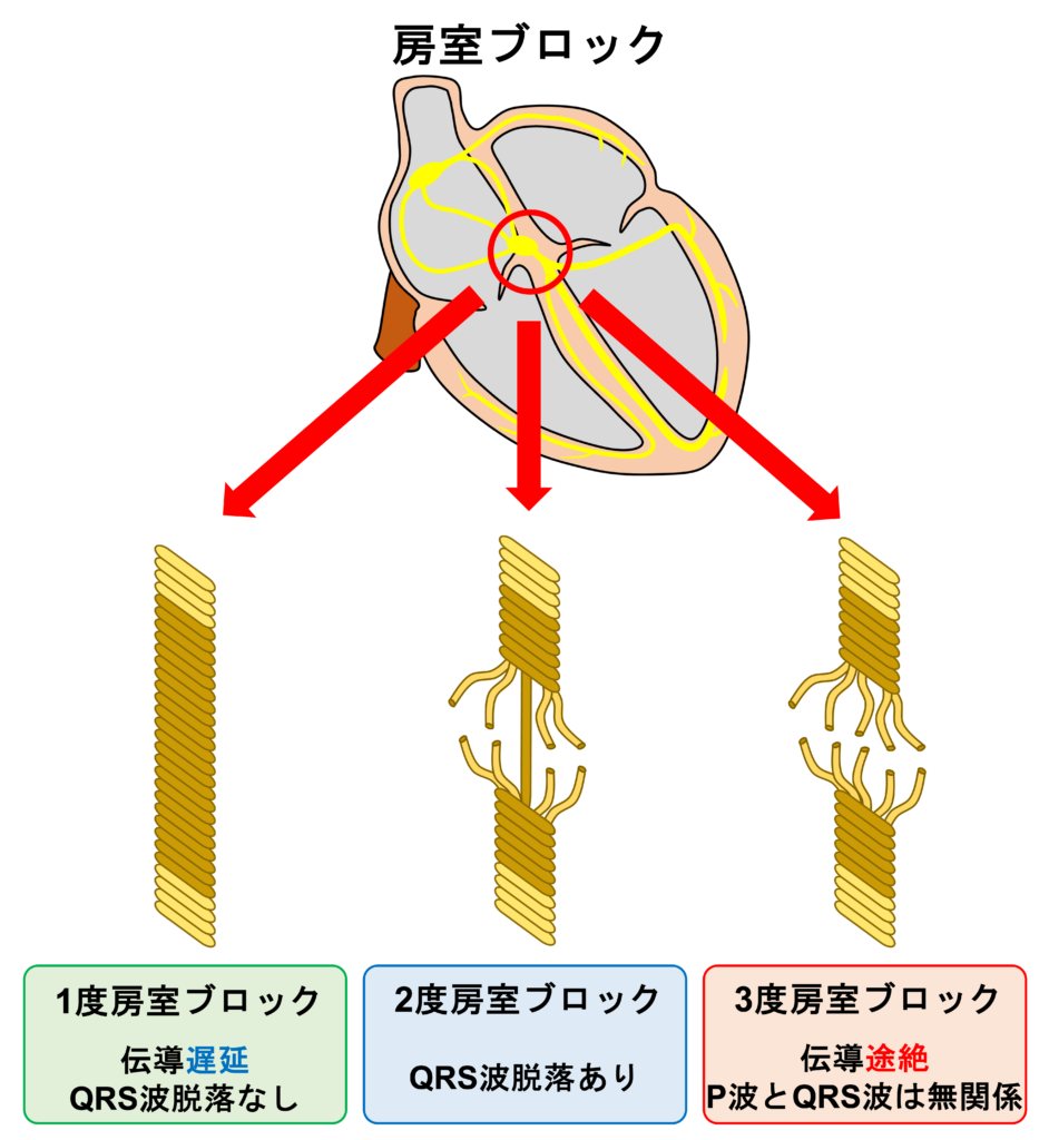 1度房室ブロック(First degree atrioventricular block)