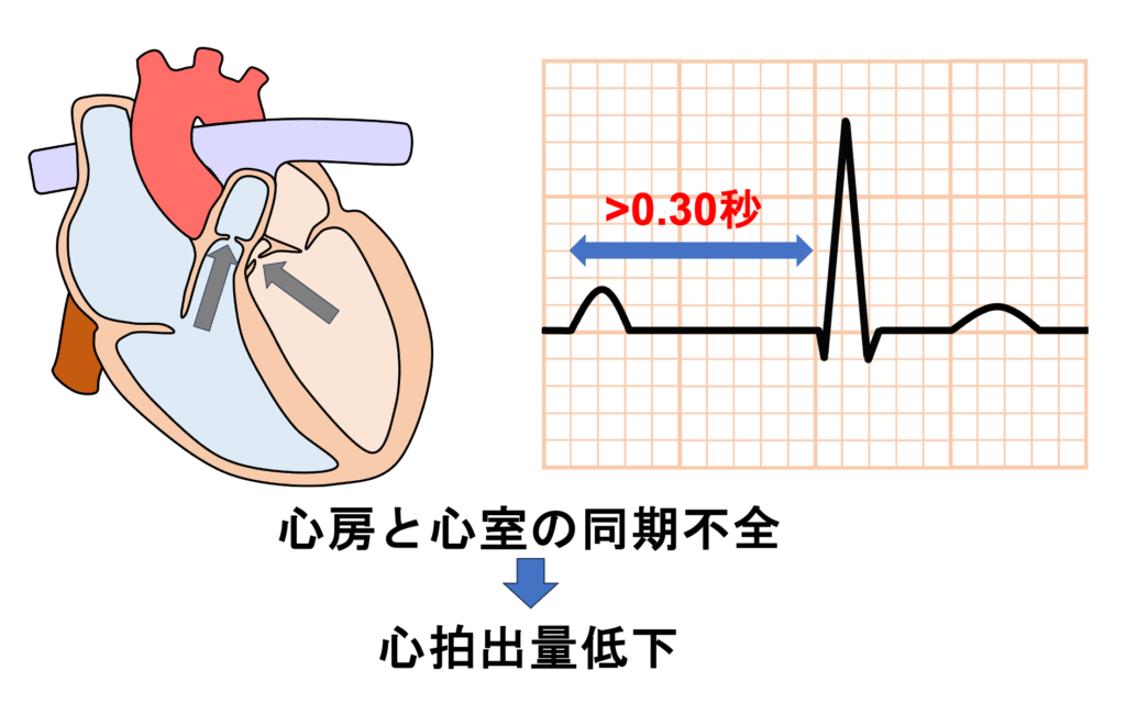 1度房室ブロック(First degree atrioventricular block)