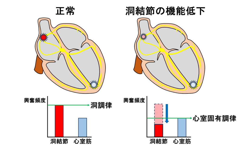 心室固有調律(idioventricular rhythm)