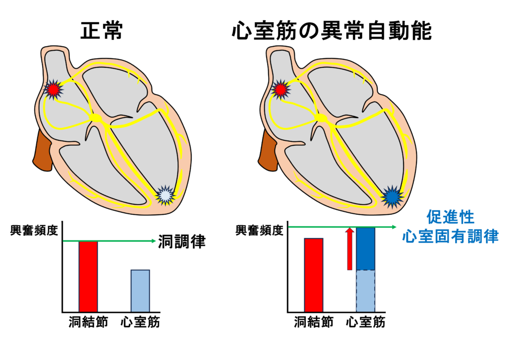 心室固有調律(idioventricular rhythm)