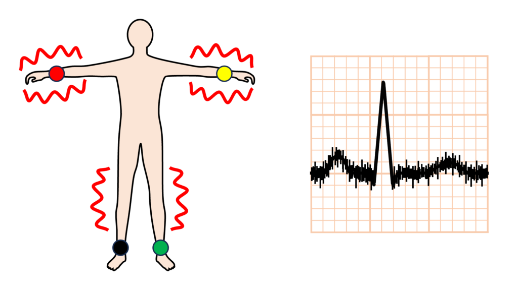 筋電図(electromyogram)