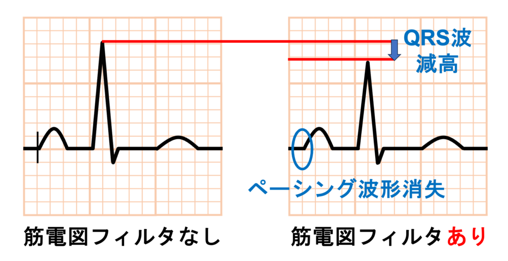 筋電図(electromyogram)