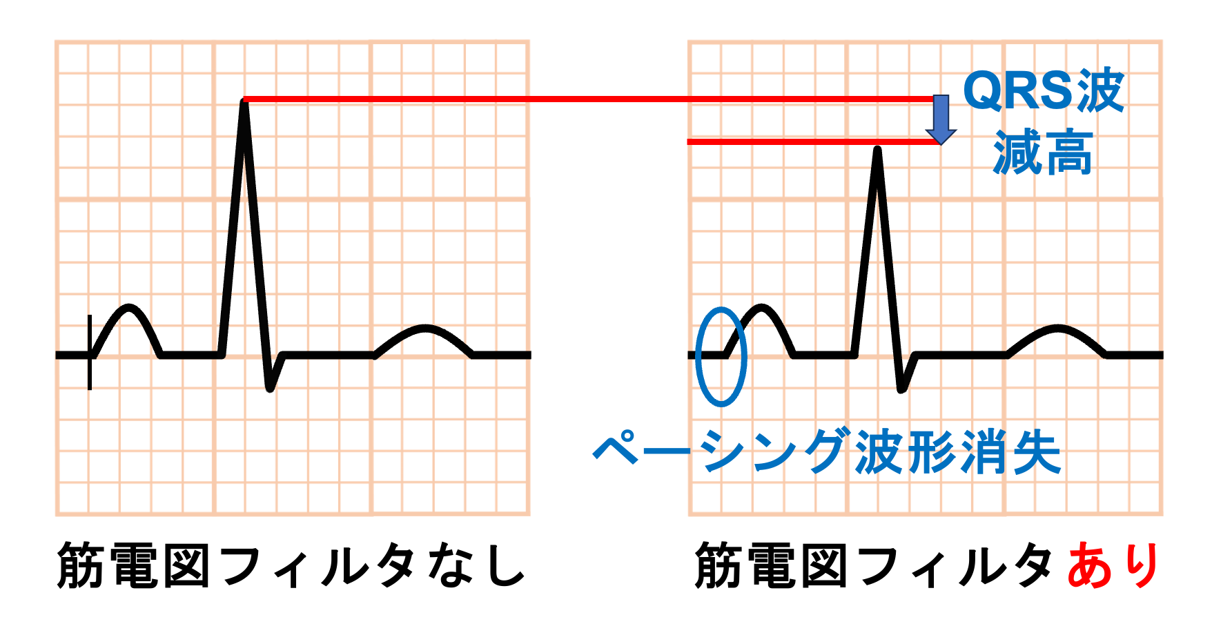 筋電図とは？ | 心電図.com