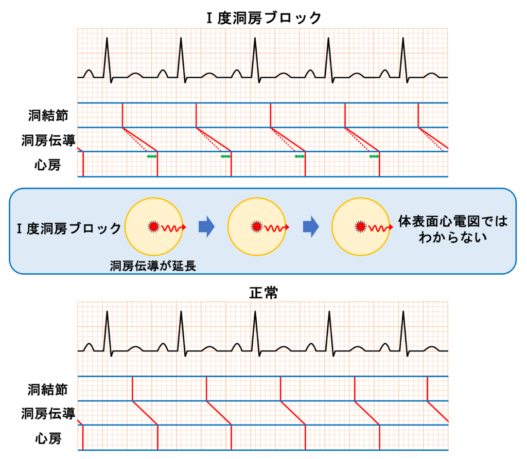 洞房ブロック(sinoatrial block)
